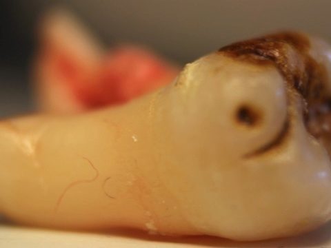 Man bleeds to death after yanking own tooth